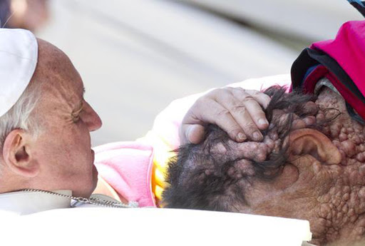 pope francis embraces man with disfigured face &#8211; fr