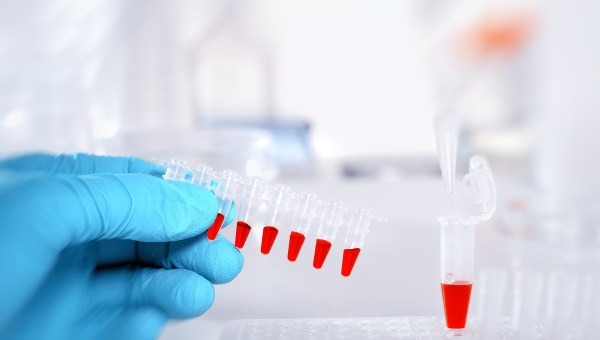 BIOMARQUEURS TRISOMIE 21